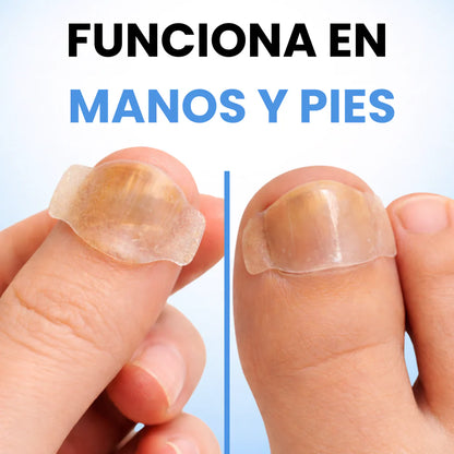 Onyclair® Parches Antihongos - Eliminan Hongos y Regeneran tus Uñas