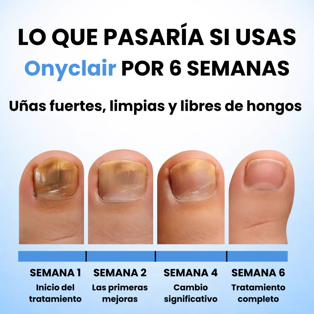 Onyclair® Parches Antihongos - Eliminan Hongos y Regeneran tus Uñas