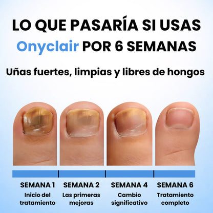 Onyclair® Parches Antihongos - Eliminan Hongos y Regeneran tus Uñas